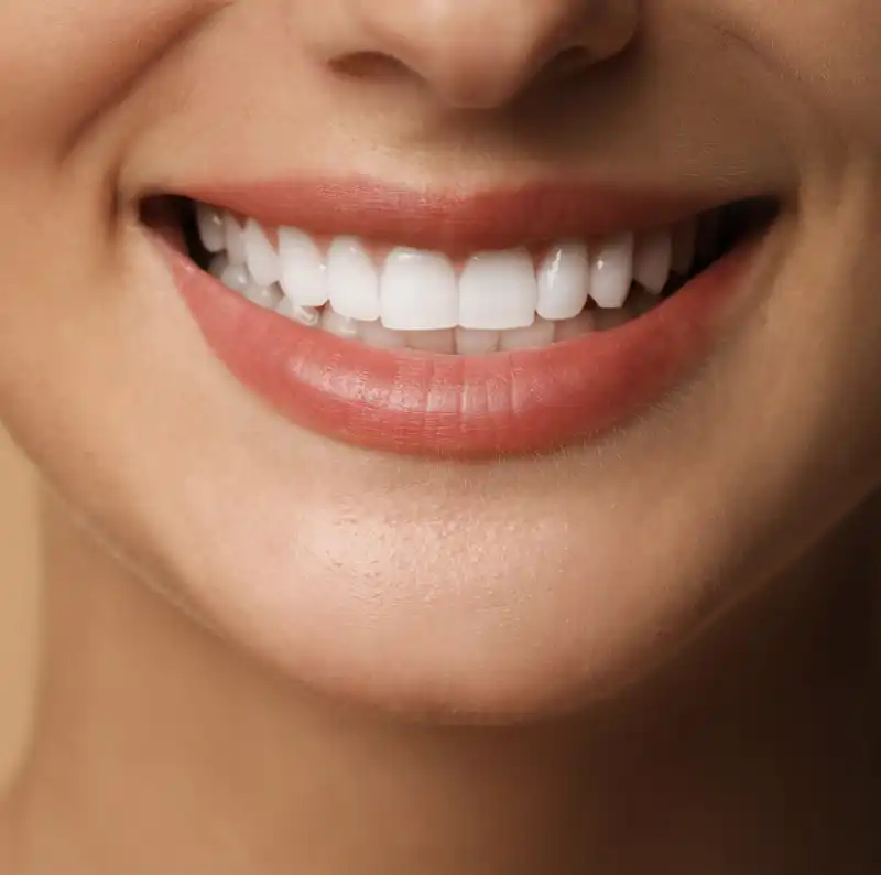 sorriso perfetto con faccette estetiche
