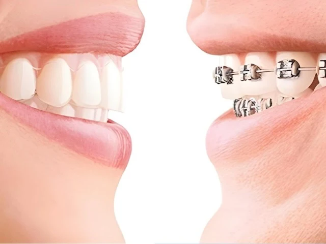 comparativa tra apparecchi ortodontici differenti